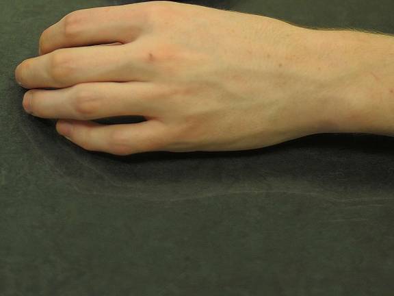 A recovering heroin addict, alias: "Ben," show his hand. Ben is now in his mid twenties. He used the drug for roughly ten years. (Photo by Joshua Rosenau)